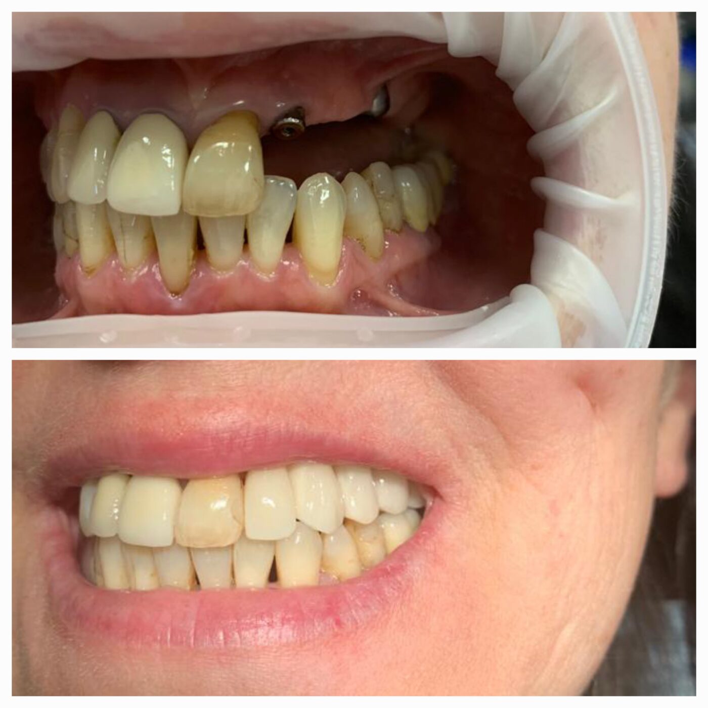 Uzupełnienie braków zębów – odbudowa cyrkonowa wsparta na implantach w Bodent
