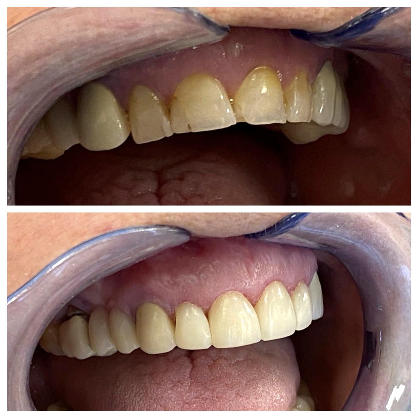 Flow injection – przywrócenie estetyki i funkcji zębów (zmiana wysokości zwarcia) za pomocą odpowiednich kompozytów w Klinice Bodent.
