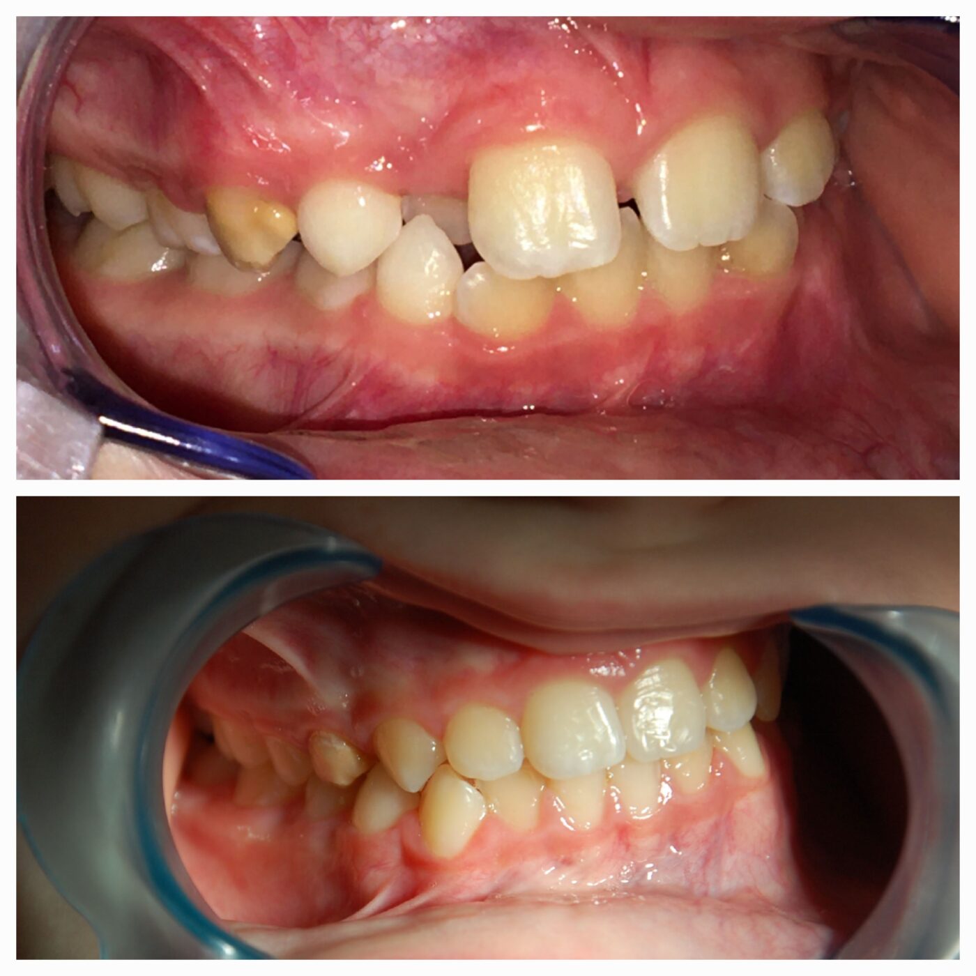Efekty leczenia ortodontycznego stałym aparatem w Klinice Bodent
