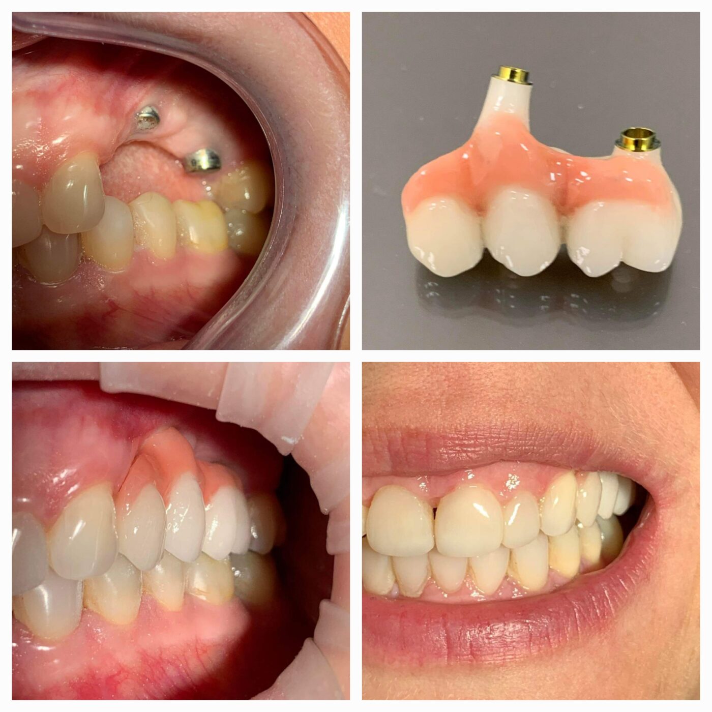 Rekonstrukcja brakujących zębów i tkanki miękkiej pacjenta 